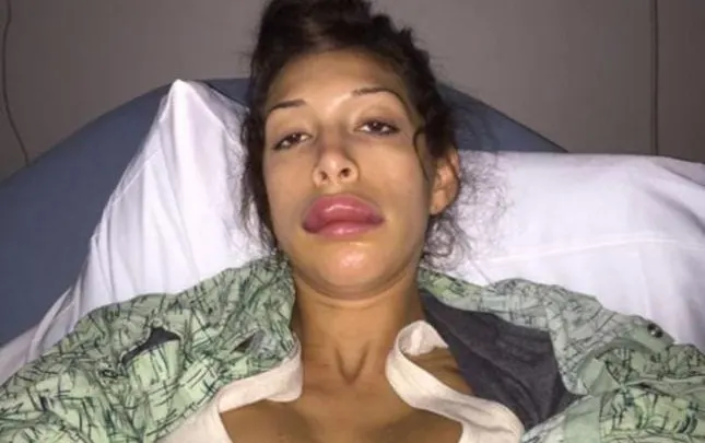 فضائح الفنانات وتعرض عارضة الازياء فرح ابراهام نفخ شفايف بعد عملية التجميل