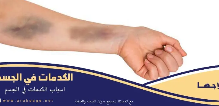 سبب ظهور الكدمات في الجسم بقع سوداء علاجها