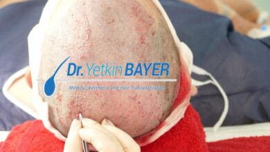 زراعة الشعر في تركيا 2020 ومعلومات افضل المستشفيات التكلفة سعر صور 3