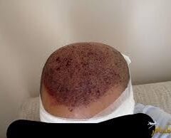 زراعة الشعر في تركيا أسعار والسياحة في تريكا 2024 كذلك صور