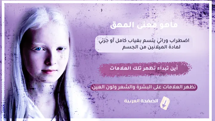 معنى مرض المهق albinism اين تبداء تظهر اعراض المهق