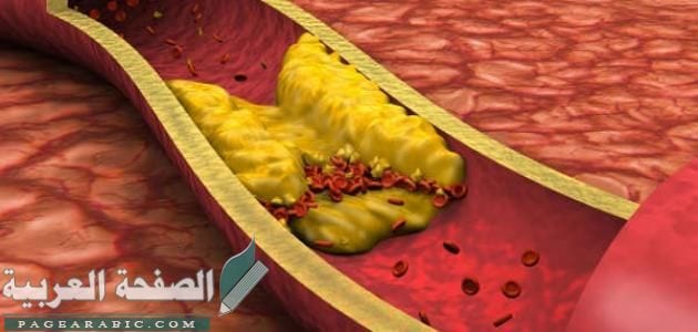 علاج ارتفاع الكولسترول وأسبابه