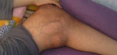 أسباب سرطان العظام وطرق علاجه