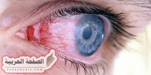 علاج آلام والتهاب العين