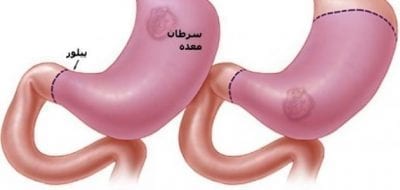 علاج سرطان الأمعاء وأسبابه