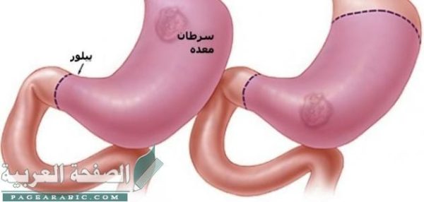علاج سرطان الأمعاء وأسبابه