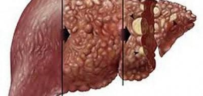 علاج سرطان الكبد وأسبابة
