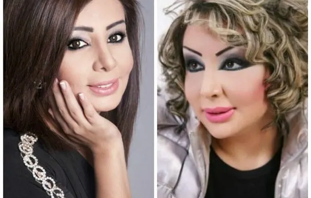 صور شيماء علي بعد عملية التجميل