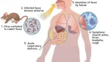 اعراض فيروس هانتا Hantaviridae والفرق بينه وبين فيروس كورونا