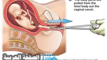 معنى abortion ماهو الإجهاض