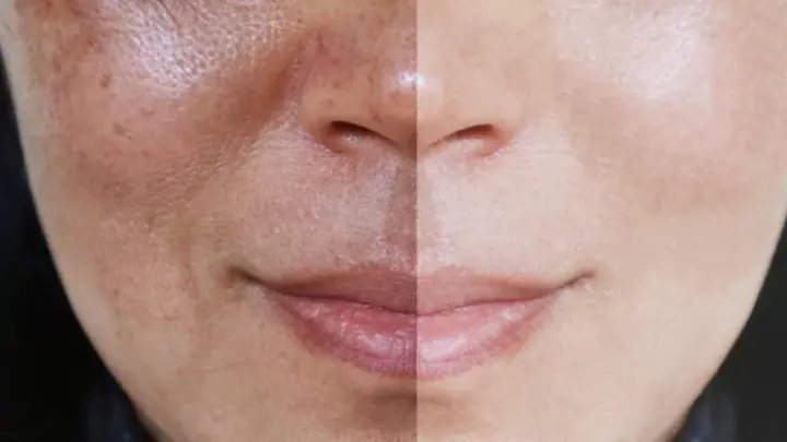 كيف التخلص من الكلف بسبب الحمل إزالة الكلف